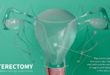 Rhian Butlin Unnecessary Hysterectomy: A Candid Expert Breakdown Rhian Butlin Unnecessary Hysterectomy